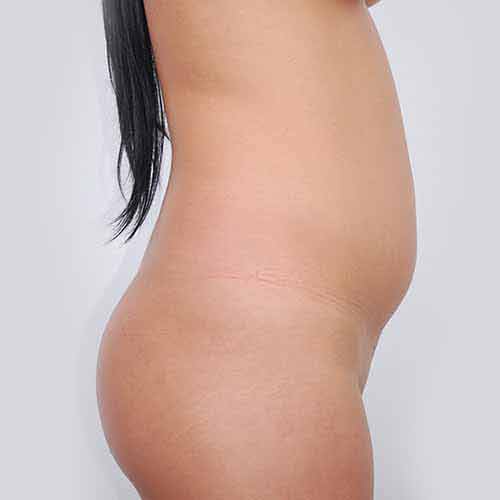 Liposuction Patient - Before Picture